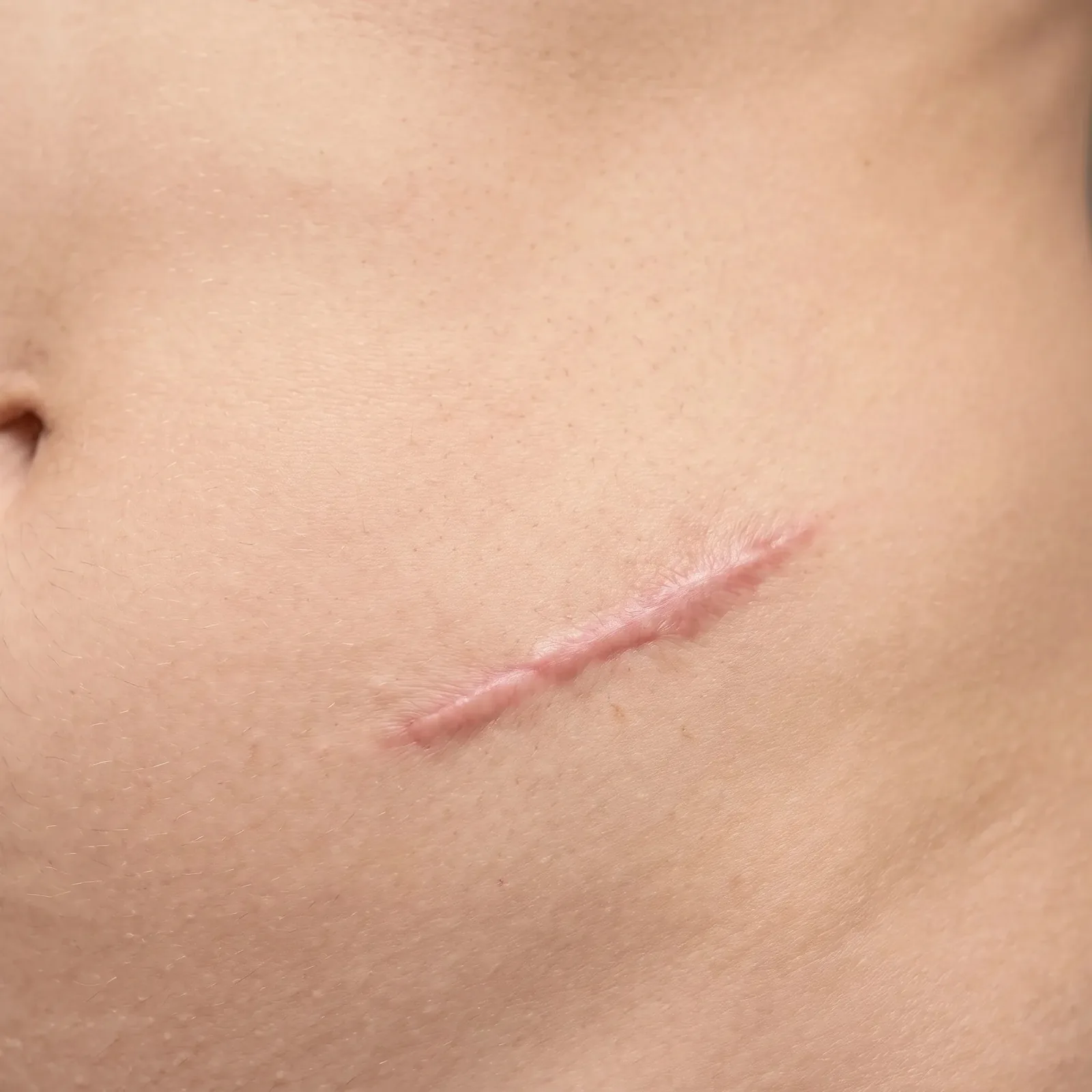 Fibrosis After Liposuction
