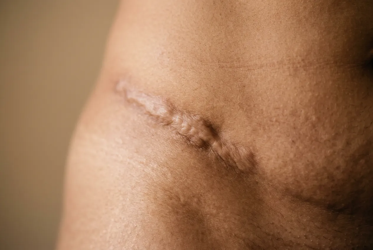 Controlled surgical trauma