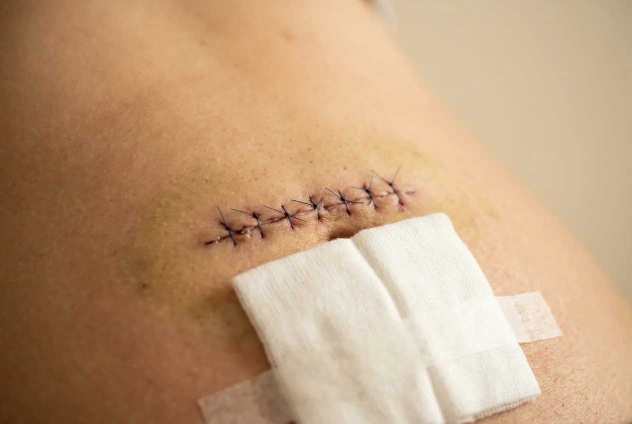 Disrupted lymphatic vessels